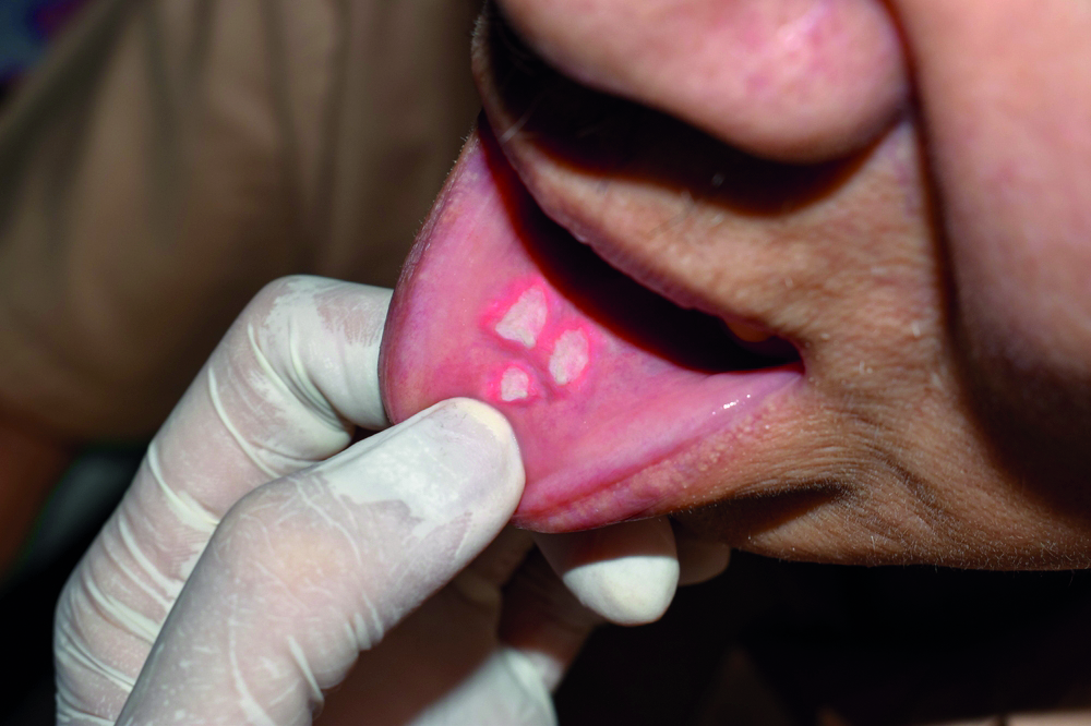 Aetiology of mouth ulcers and pain management techniques