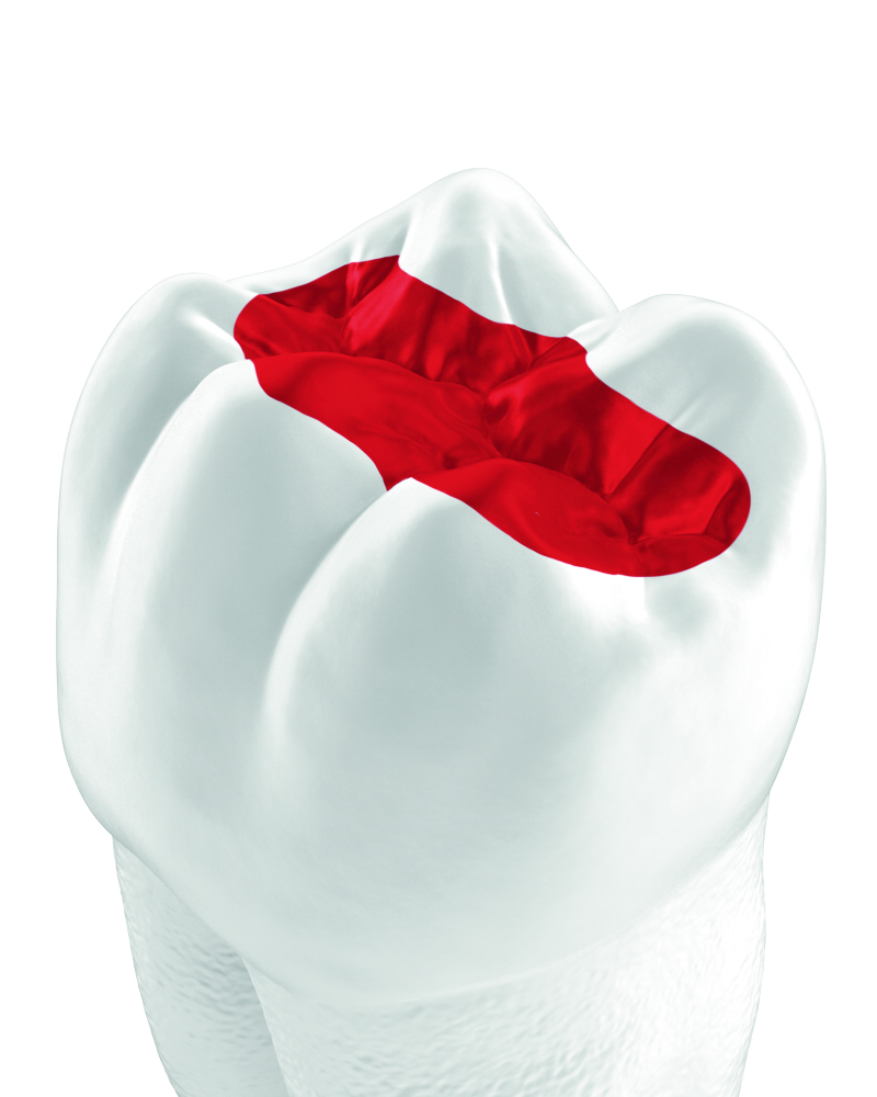 The role of glass hybrids as an alternative to dental amalgam
