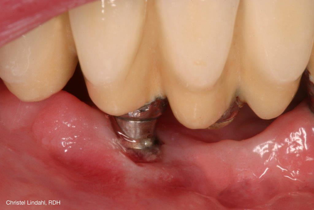 Understanding and preventing peri-implant disease