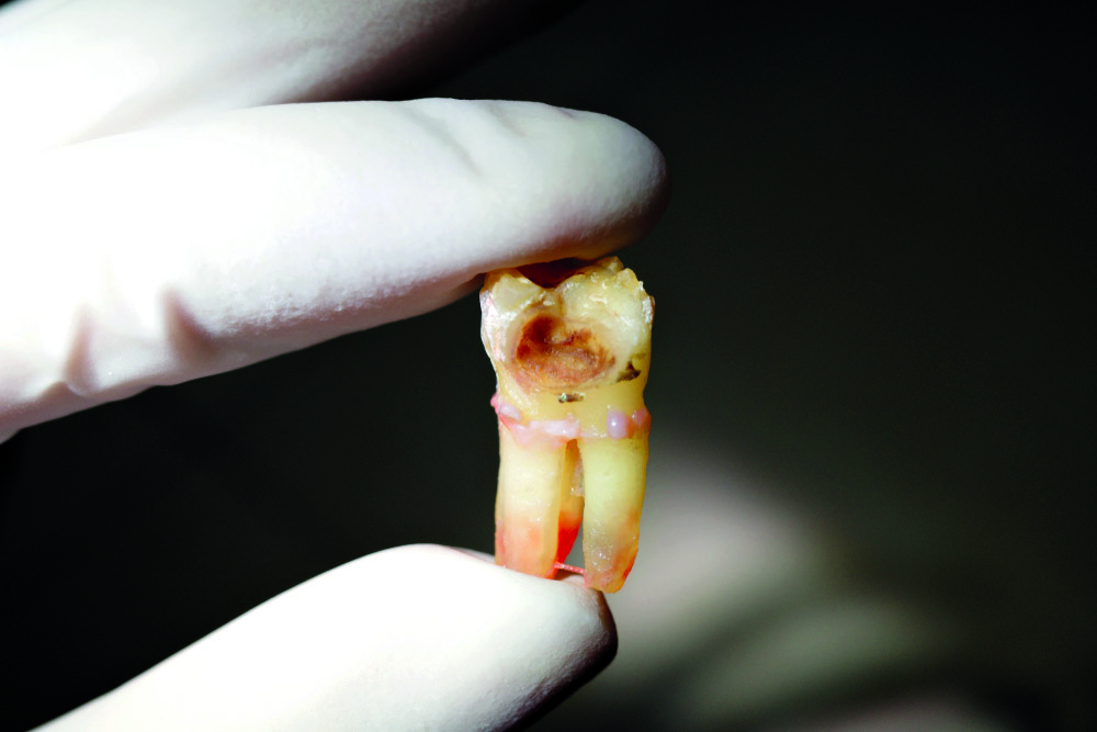 Preventing the necrotic pulp