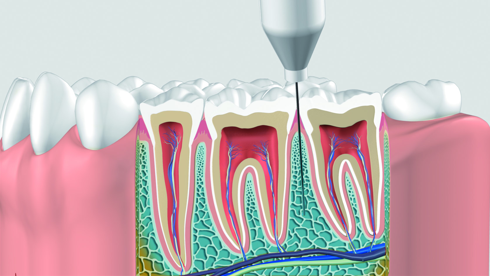 Digitally controlled, intraosseous dental anesthesia with QuickSleeper