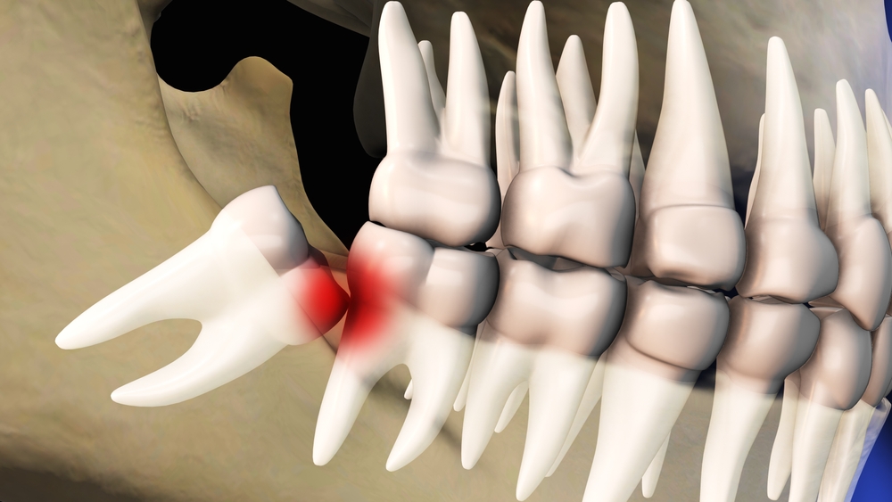 Management of wisdom tooth pain