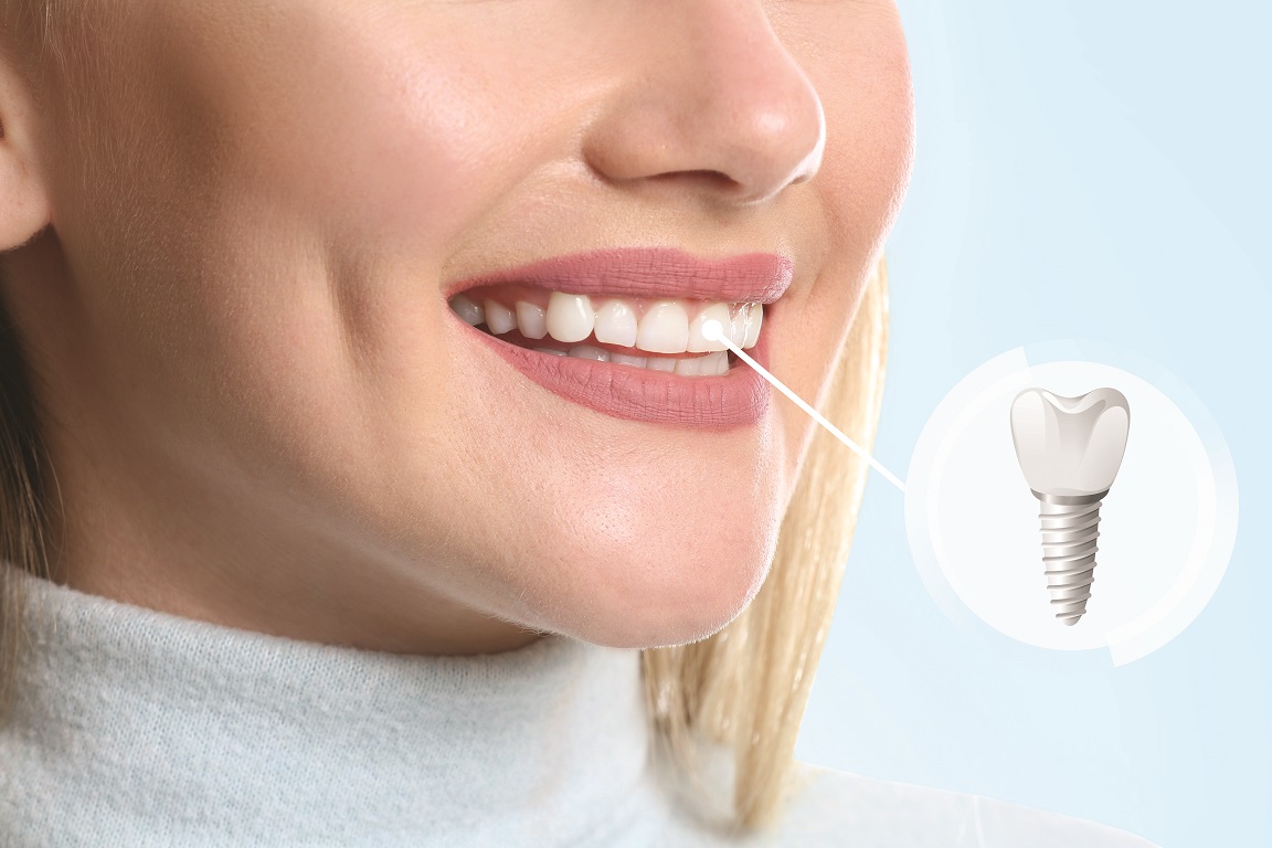 Protecting implants starts with prevention