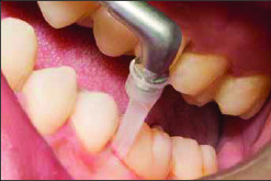 Treatment of periodontitis and minimally invasive treatment with modern technology