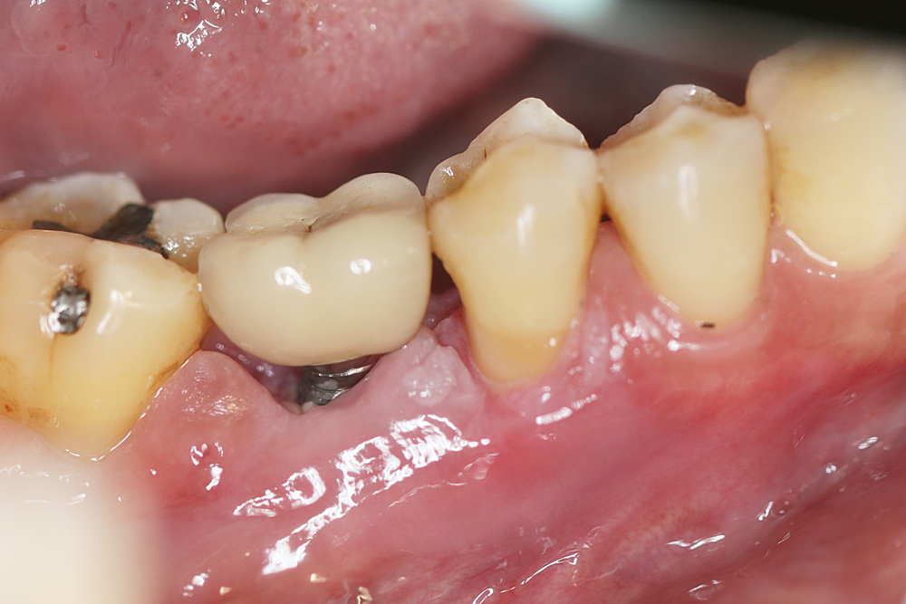 Predicting and preventing peri-implantitis