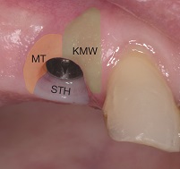 Peri-implant phenotype: the mucosal seal — an overlooked cornerstone of implant health
