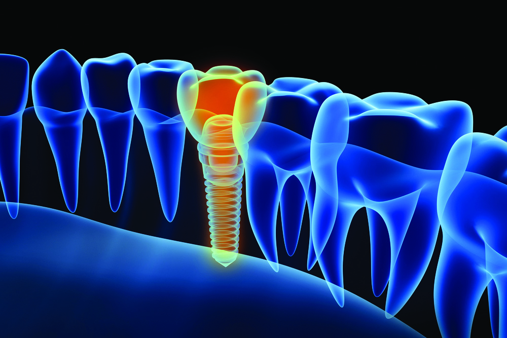 Maximising implant success with timely interventions